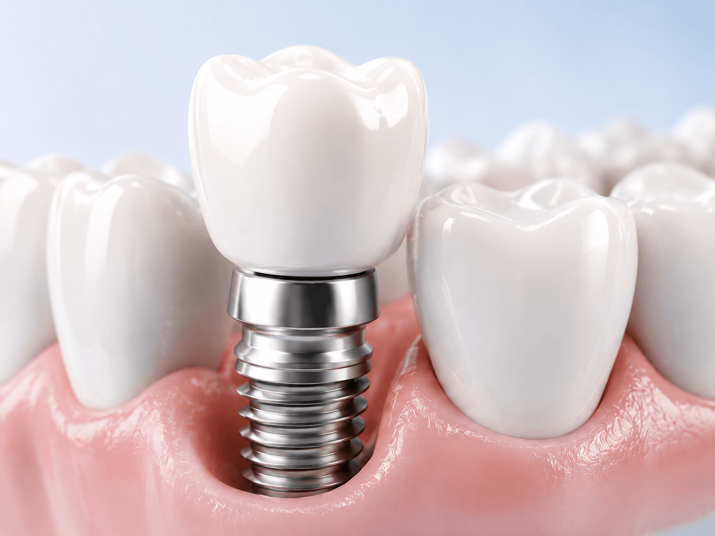 What You Need to Know Before Implant Treatment